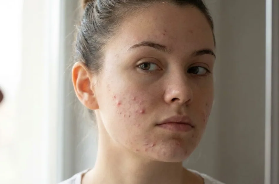 ragazza con brufoli sottopelle del viso