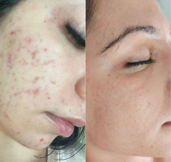 prima e dopo viso acne e brufoli .jpg