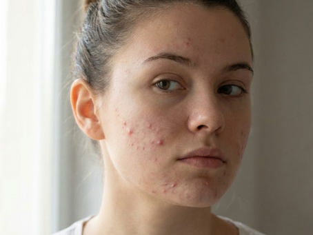 Brufoli sottopelle sul viso: Perché schiacciarli è l’errore che pagherai caro (e come eliminarli davvero)