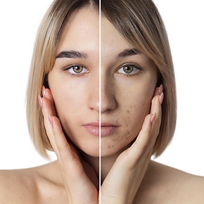 ragazza prima e dopo con brufoli su viso.jpg