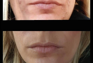 prima e dopo meri mento.jpg