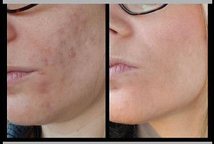 prima e dopo meri viso acne e brufoli.jpg