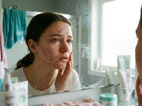 Riflessi nello Specchio: come Sconfiggere i Brufoli sul viso ad Asti con Metodo